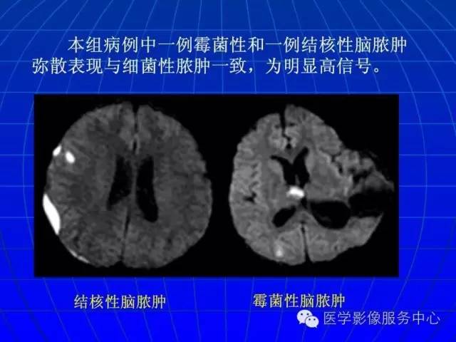 【PPT】脑脓肿磁共振加权成像动态变化