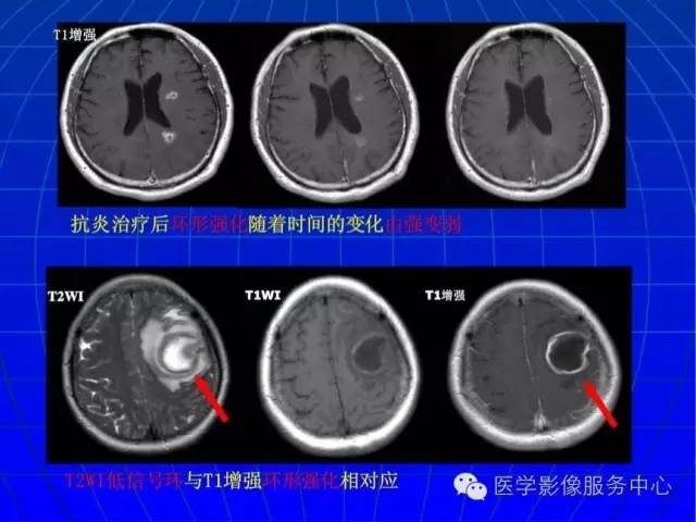 【PPT】脑脓肿磁共振加权成像动态变化