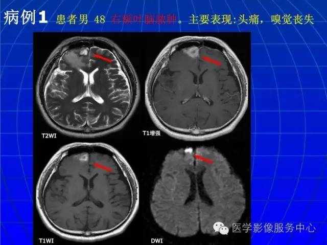【PPT】脑脓肿磁共振加权成像动态变化