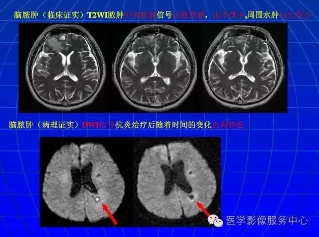 【PPT】脑脓肿磁共振加权成像动态变化