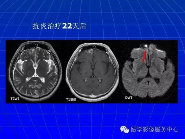 【PPT】脑脓肿磁共振加权成像动态变化