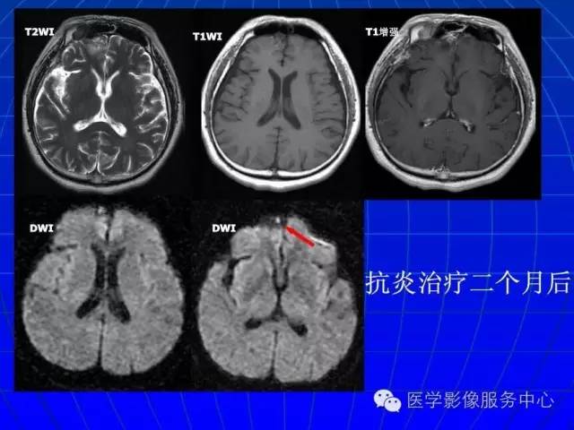 【PPT】脑脓肿磁共振加权成像动态变化