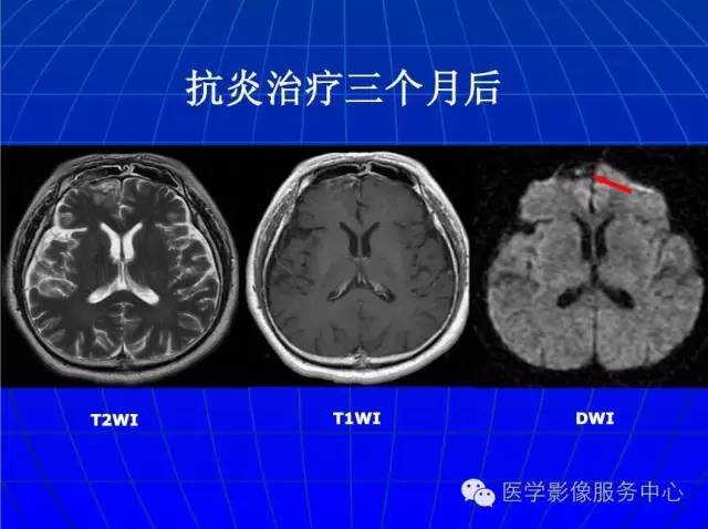 【PPT】脑脓肿磁共振加权成像动态变化
