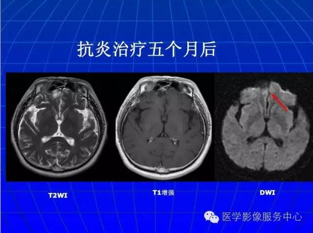 【PPT】脑脓肿磁共振加权成像动态变化