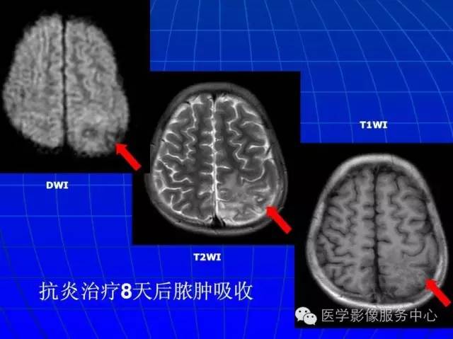 【PPT】脑脓肿磁共振加权成像动态变化