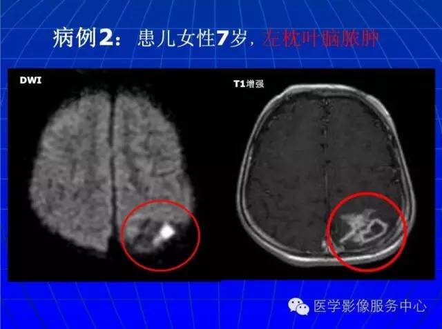 【PPT】脑脓肿磁共振加权成像动态变化