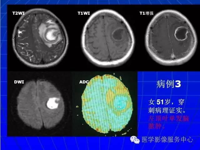 【PPT】脑脓肿磁共振加权成像动态变化