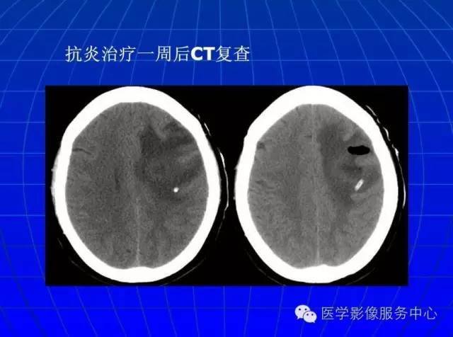 【PPT】脑脓肿磁共振加权成像动态变化