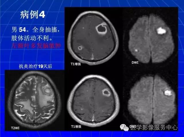 【PPT】脑脓肿磁共振加权成像动态变化
