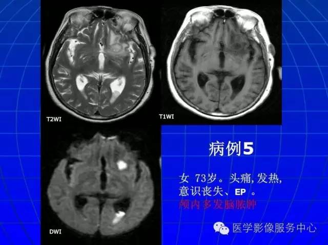 【PPT】脑脓肿磁共振加权成像动态变化