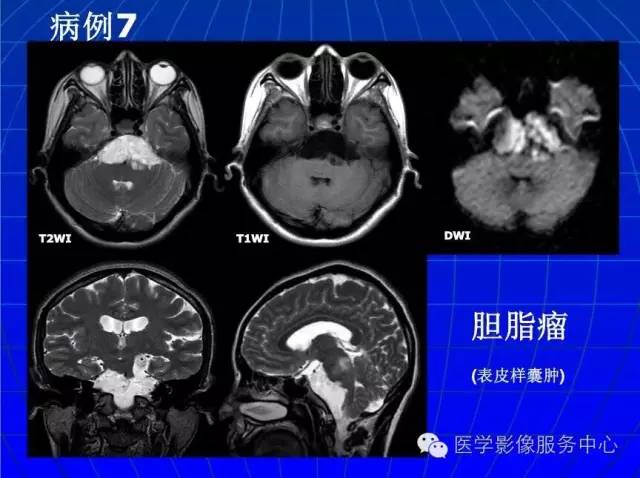 【PPT】脑脓肿磁共振加权成像动态变化