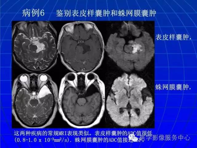 【PPT】脑脓肿磁共振加权成像动态变化