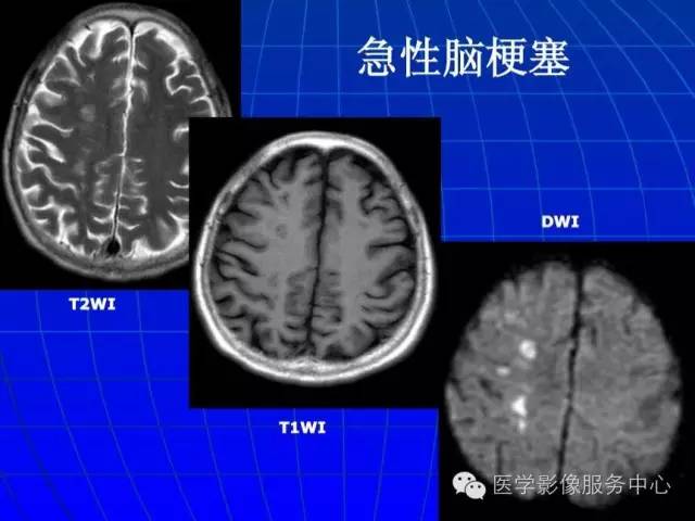 【PPT】脑脓肿磁共振加权成像动态变化