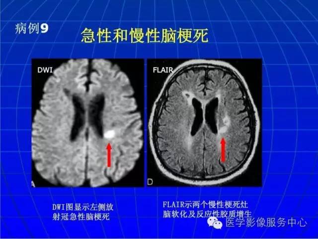 【PPT】脑脓肿磁共振加权成像动态变化