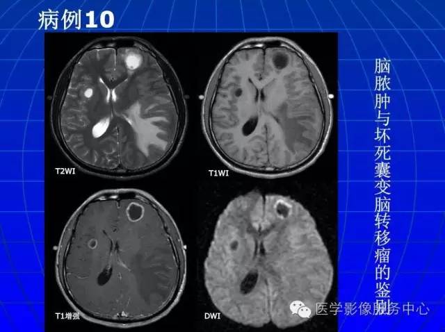 【PPT】脑脓肿磁共振加权成像动态变化