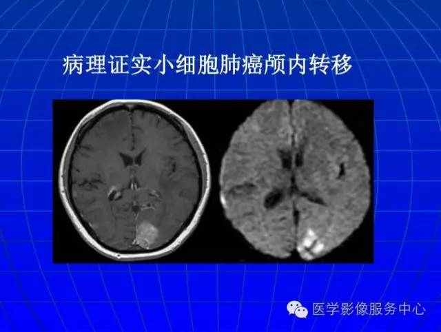 【PPT】脑脓肿磁共振加权成像动态变化