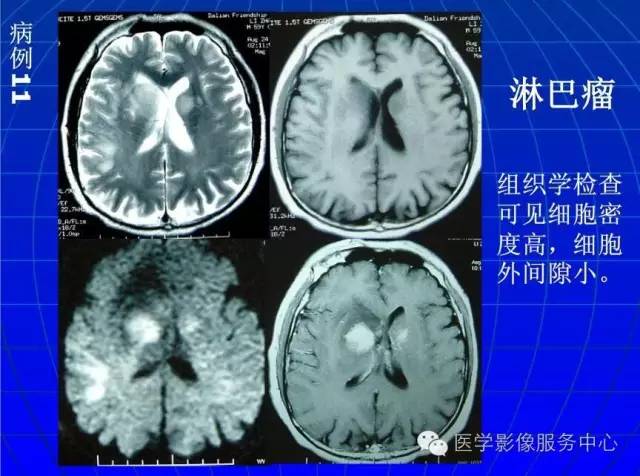 【PPT】脑脓肿磁共振加权成像动态变化