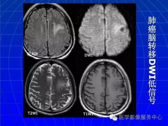 【PPT】脑脓肿磁共振加权成像动态变化