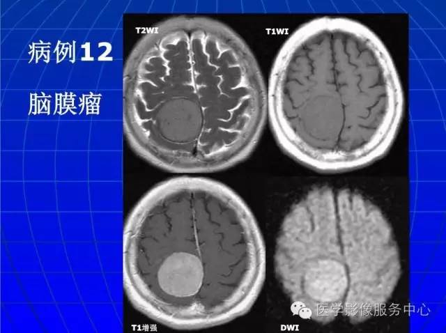 【PPT】脑脓肿磁共振加权成像动态变化