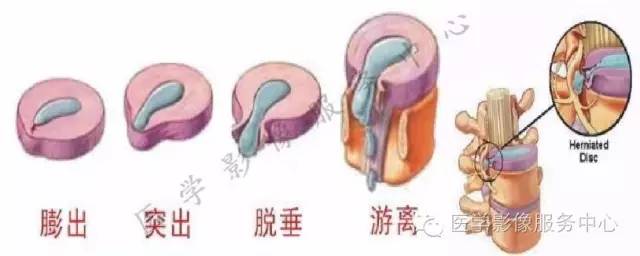 椎间盘突出的病理与CT分型 椎间盘突出的病理与CT分型