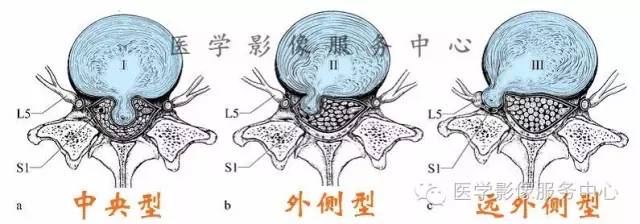 椎间盘突出的病理与CT分型 椎间盘突出的病理与CT分型