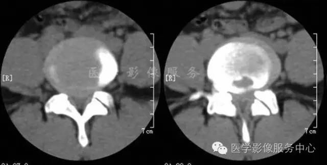 椎间盘突出的病理与CT分型
