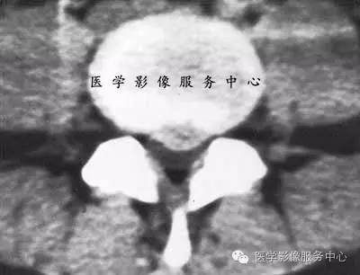 椎间盘突出的病理与CT分型 椎间盘突出的病理与CT分型