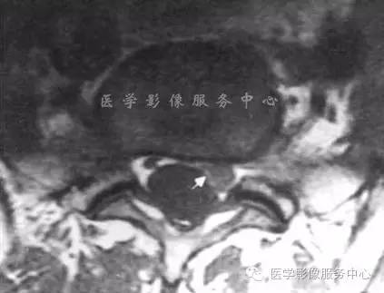 椎间盘突出的病理与CT分型 椎间盘突出的病理与CT分型