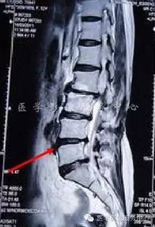 椎间盘突出的病理与CT分型 椎间盘突出的病理与CT分型