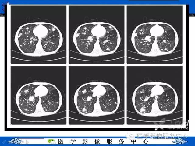 【病例】HIV引起的肺内多发病变——卡波济氏肉瘤1例CT