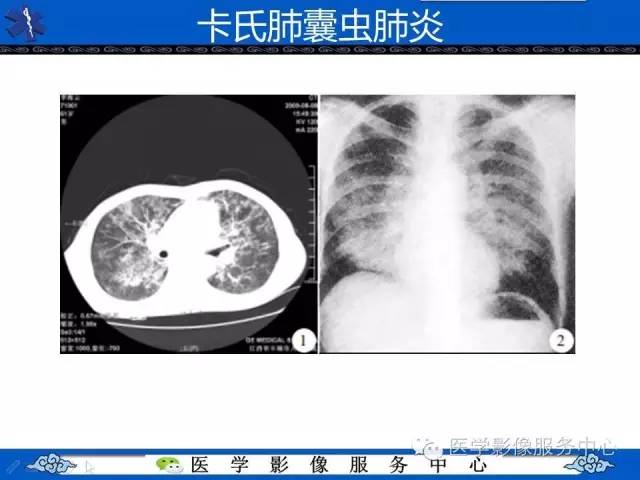 【病例】HIV引起的肺内多发病变——卡波济氏肉瘤1例CT