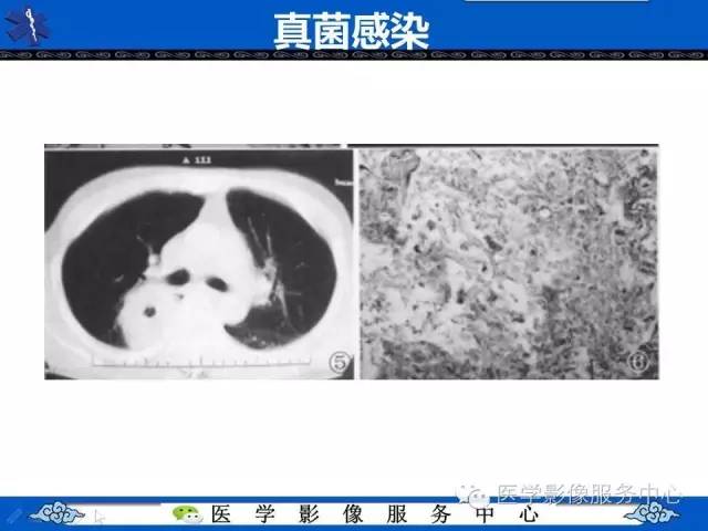 【病例】HIV引起的肺内多发病变——卡波济氏肉瘤1例CT