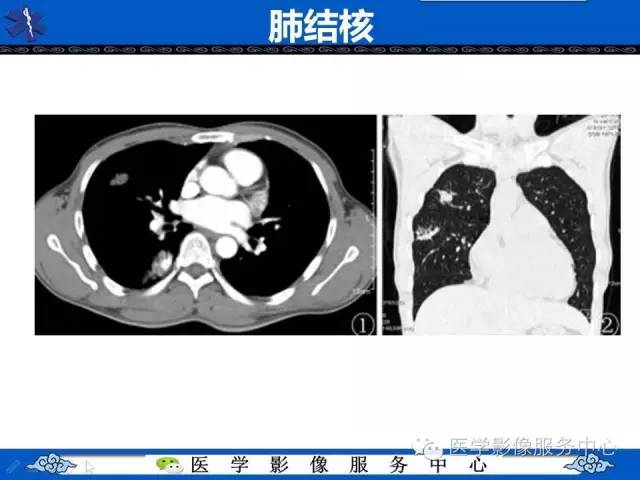【病例】HIV引起的肺内多发病变——卡波济氏肉瘤1例CT