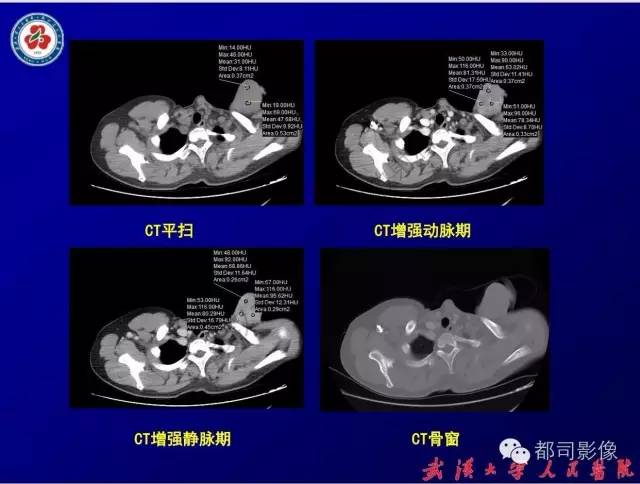 【病例】皮肤纤维肉瘤1例CT影像表现与鉴别