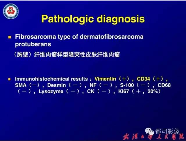 【病例】皮肤纤维肉瘤1例CT影像表现与鉴别