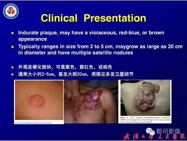 【病例】皮肤纤维肉瘤1例CT影像表现与鉴别