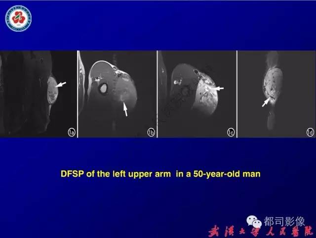 【病例】皮肤纤维肉瘤1例CT影像表现与鉴别