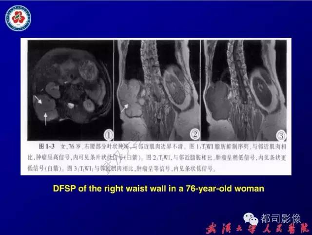 【病例】皮肤纤维肉瘤1例CT影像表现与鉴别