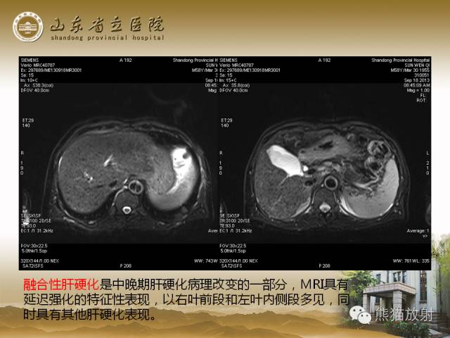 【PPT】肝脏影像学培训内容