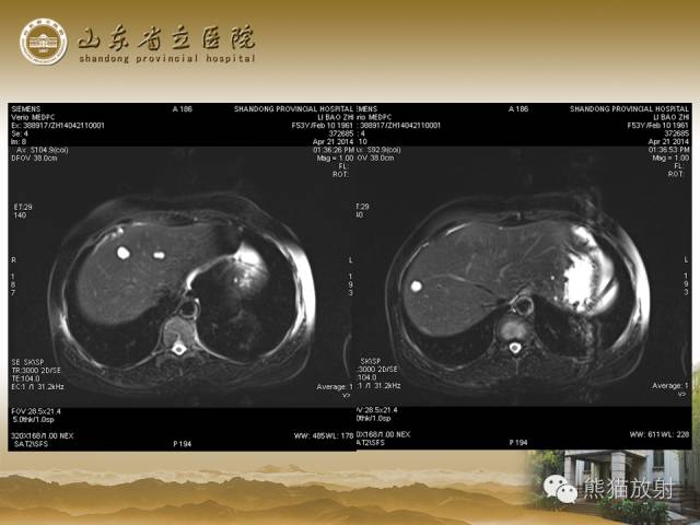 【PPT】肝脏影像学培训内容