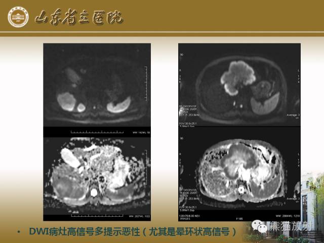 【PPT】肝脏影像学培训内容