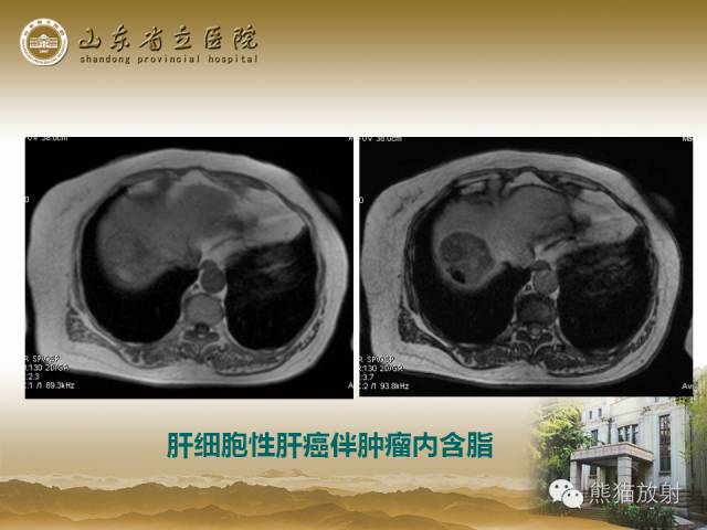 【PPT】肝脏影像学培训内容