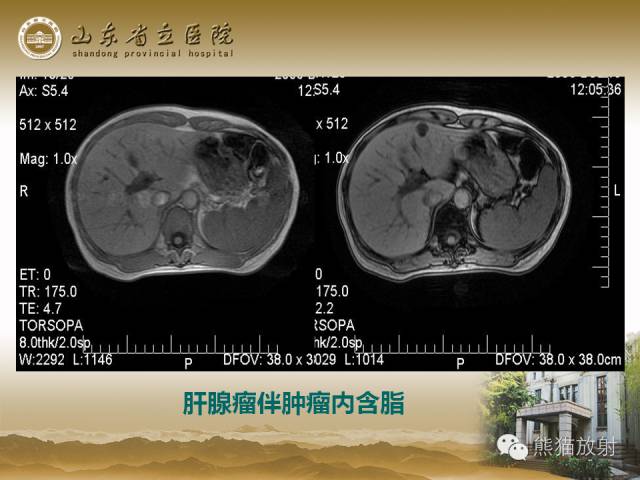 【PPT】肝脏影像学培训内容