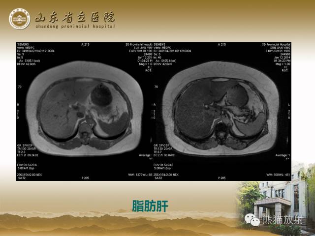 【PPT】肝脏影像学培训内容