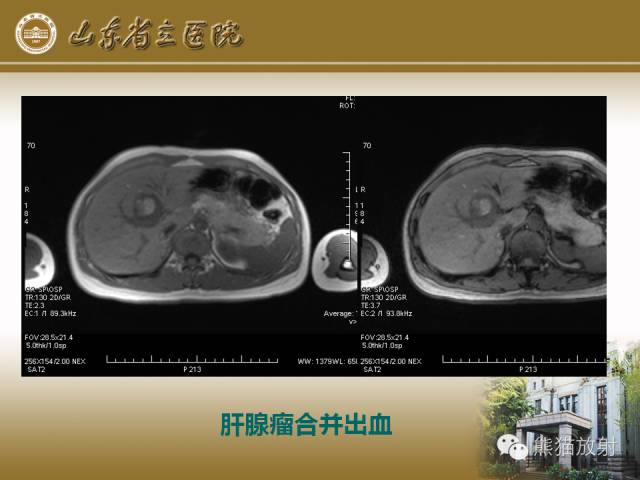 【PPT】肝脏影像学培训内容