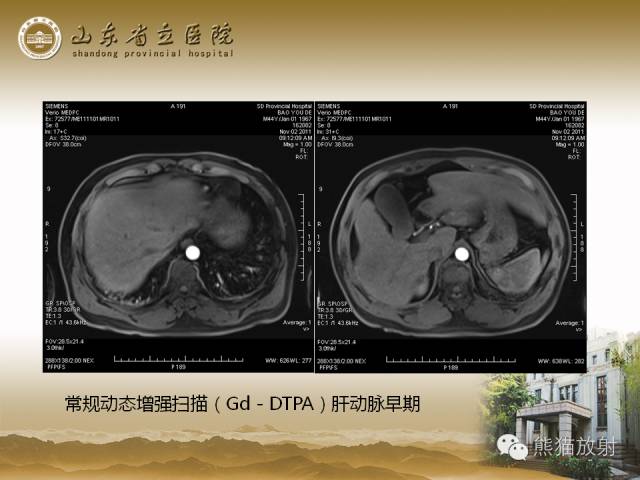 【PPT】肝脏影像学培训内容