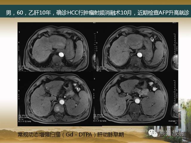 【PPT】肝脏影像学培训内容