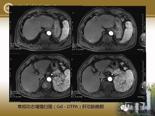 【PPT】肝脏影像学培训内容
