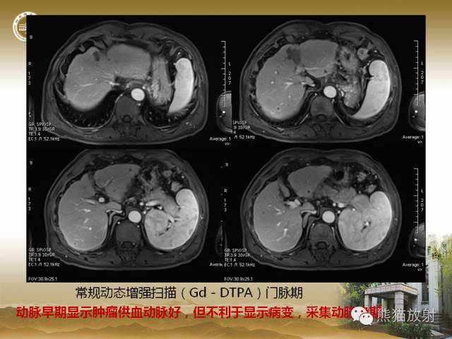 【PPT】肝脏影像学培训内容