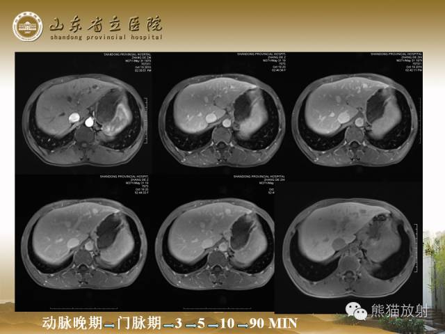 【PPT】肝脏影像学培训内容